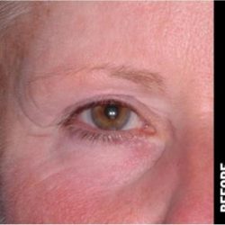 Ultherapy Before & After Patient #1547